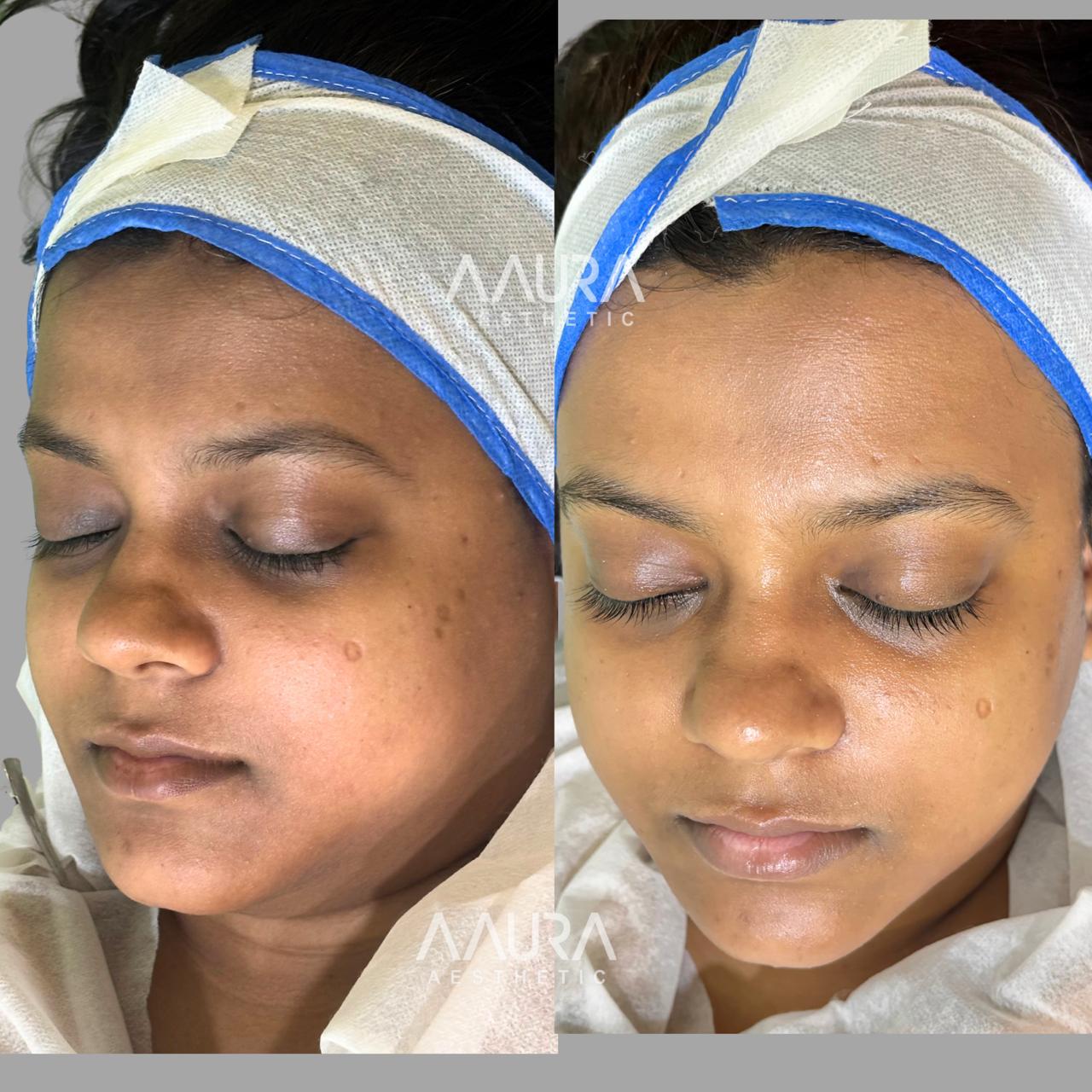 Korean Glass Skin Therapy In Aaura Aesthetic Clinic